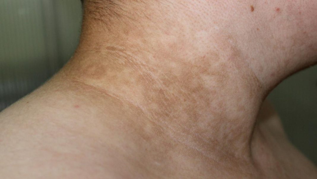 Ukoliko primetite ove TAMNE FLEKE na vratu, obavezno zakažite PREGLED! Doktor kaže da može biti SIMPTOM opake BOLESTI - featured image Ukoliko primetite ove TAMNE FLEKE na vratu, obavezno zakažite PREGLED! Doktor kaže da može biti SIMPTOM opake BOLESTI - featured image