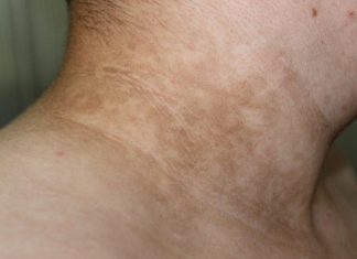 Ukoliko primetite ove TAMNE FLEKE na vratu, obavezno zakažite PREGLED! Doktor kaže da može biti SIMPTOM opake BOLESTI Ukoliko primetite ove TAMNE FLEKE na vratu, obavezno zakažite PREGLED! Doktor kaže da može biti SIMPTOM opake BOLESTI - featured image