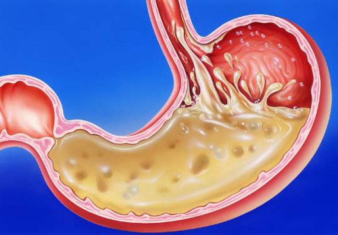 GUŠI VAS KISELINA U ŽELUCU - RIJEŠITE SE GORUŠICE I PODRIGIVANJA NA PRIRODAN NAČIN: Treba vam samo 1 namirnica - featured image GUŠI VAS KISELINA U ŽELUCU - RIJEŠITE SE GORUŠICE I PODRIGIVANJA NA PRIRODAN NAČIN: Treba vam samo 1 namirnica - featured image